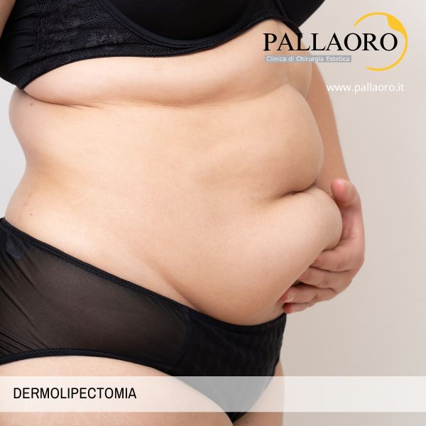 Dermolipectomia dermolipectomia