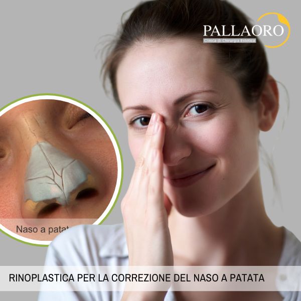 Rinoplastica per la correzione del naso a patata