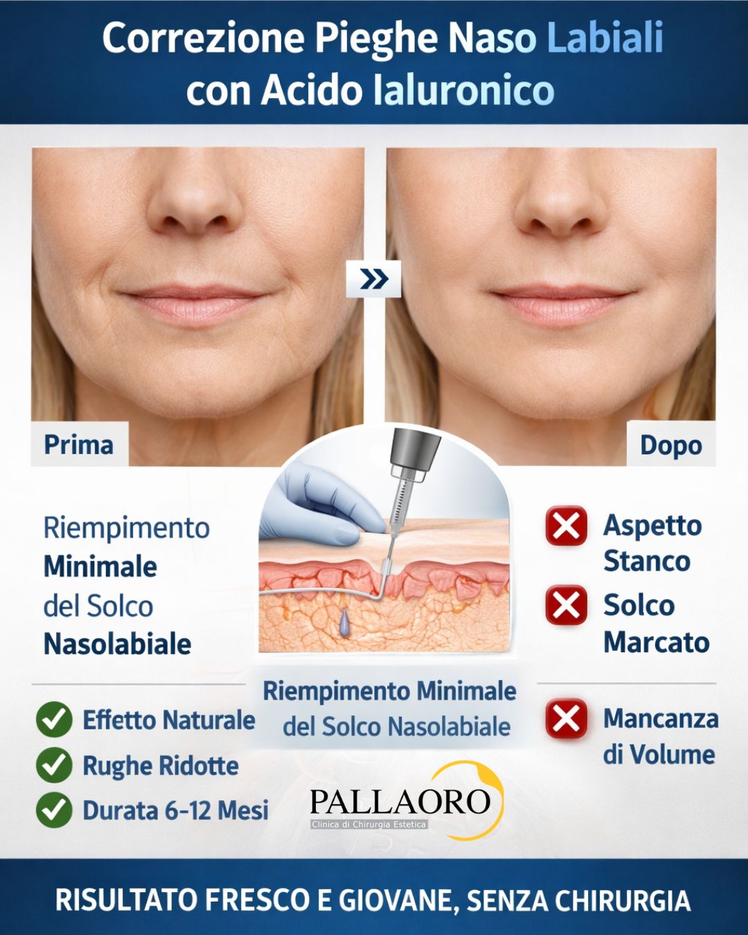 acido ialuronico pieghe naso labiali