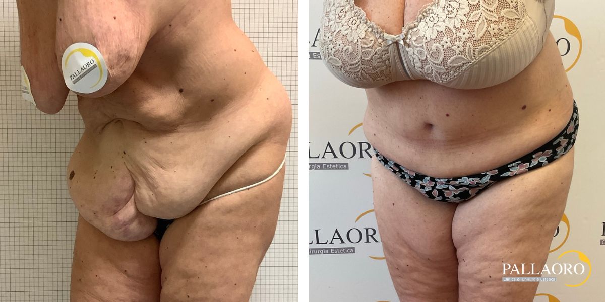 addominoplastica rilassamento addominale severo prolasso cutaneo (1)
