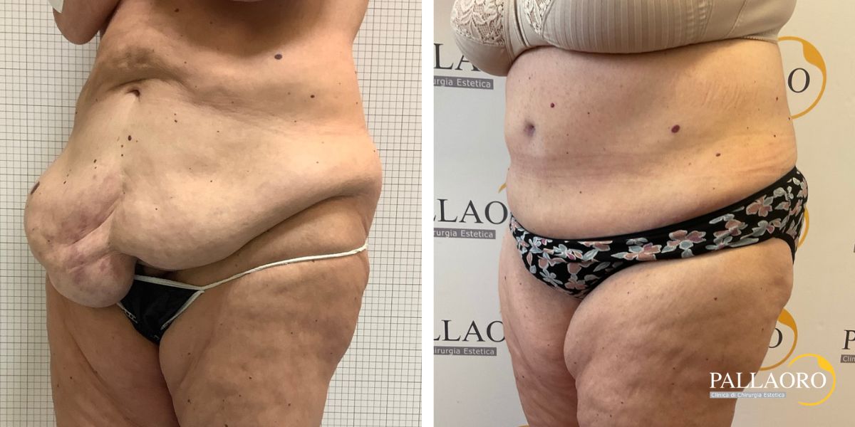 addominoplastica rilassamento addominale severo prolasso cutaneo (2)