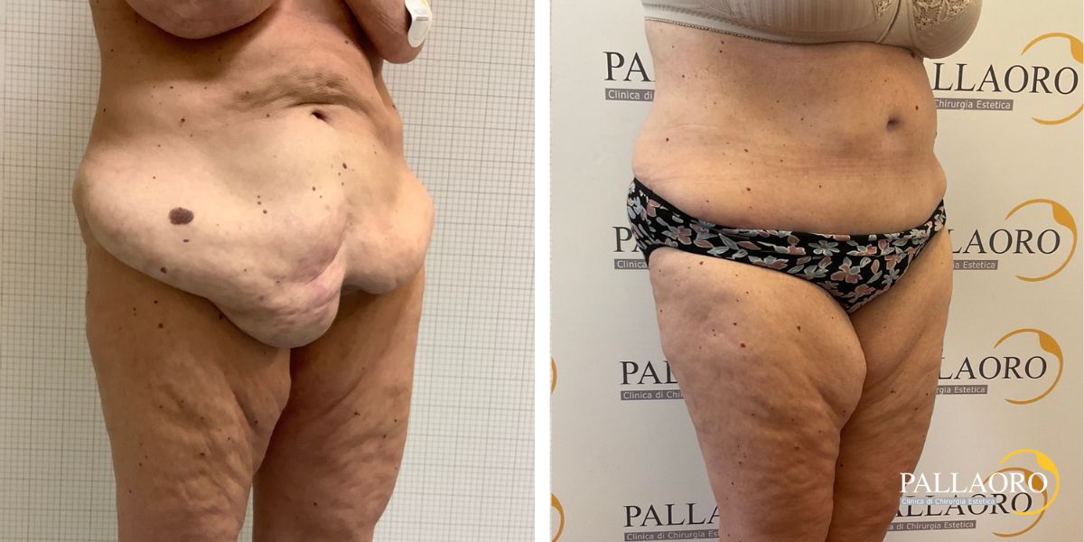 addominoplastica rilassamento addominale severo prolasso cutaneo (3)