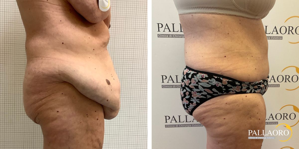 addominoplastica rilassamento addominale severo prolasso cutaneo (4)