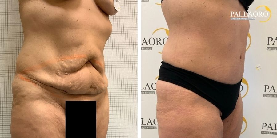 Addome con pieghe cutanee prima e dopo addominoplastica, vista laterale obliqua