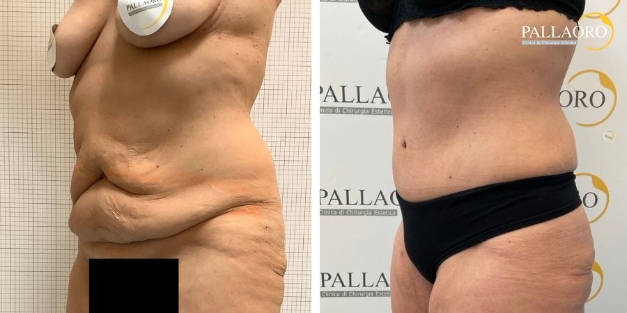 Eccesso cutaneo dell’addome prima e profilo laterale dopo addominoplastica