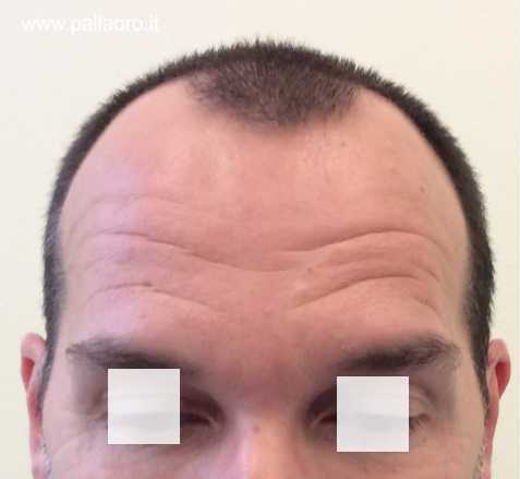 Alopecia androgenetica cause determinate geneticamente