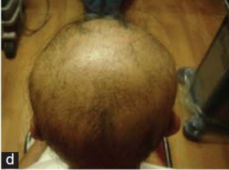 Alopecia areata 01