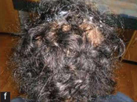 Alopecia areata 06