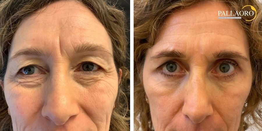 Vista frontale prima e dopo del contorno occhi nel caso di blefaroplastica completa e laser frazionato