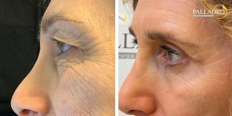 Secondo profilo prima e dopo del contorno occhi dopo blefaroplastica completa e laser frazionato