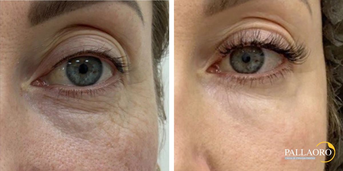 blefaroplastica non chirurgica prima dopo