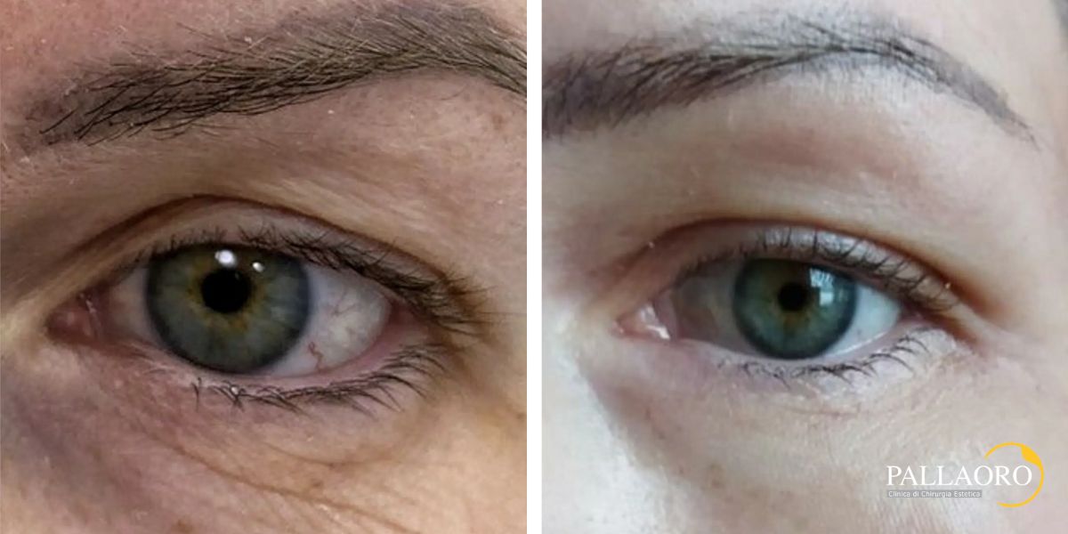 blefaroplastica non chirurgica (2)