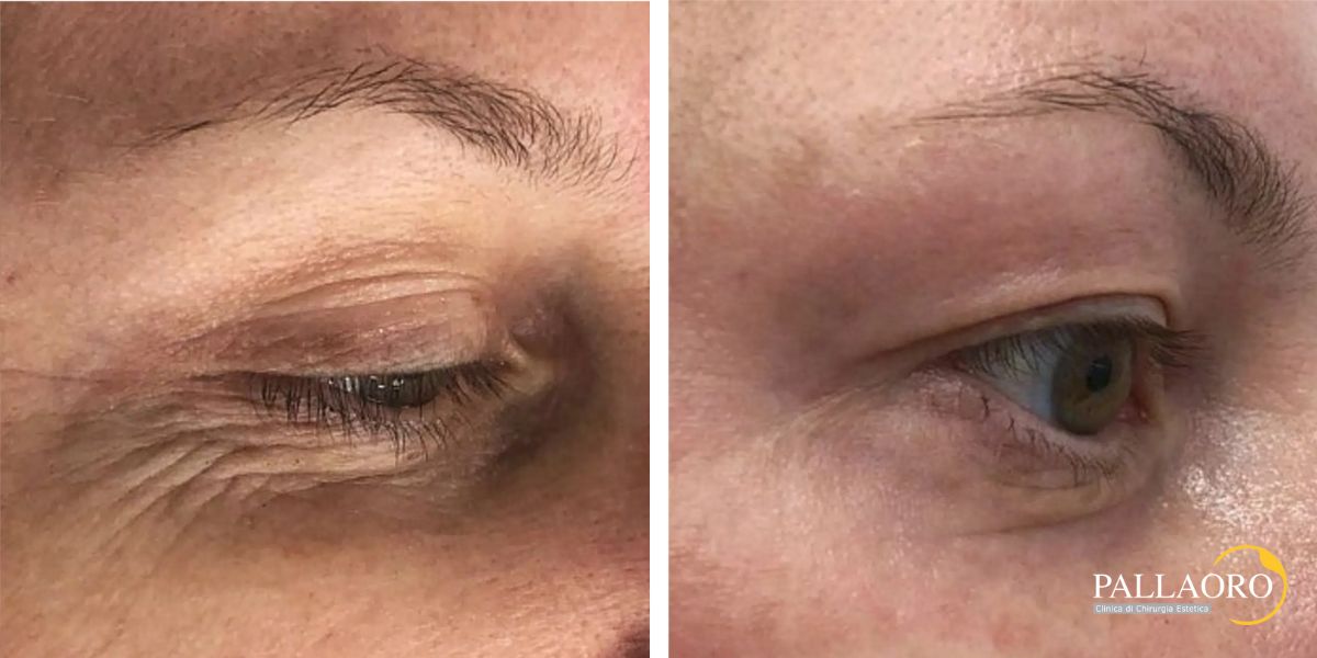 blefaroplastica non chirurgica (3)
