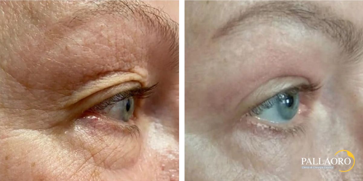 blefaroplastica non chirurgica (4)