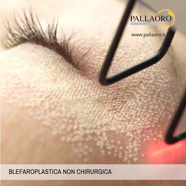 blefaroplastica non chirurgica blefaroplastica non chirurgica