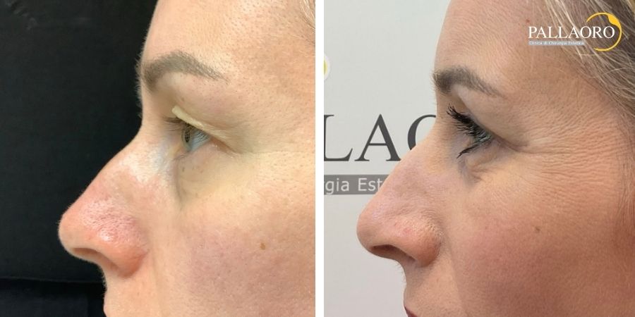 blefaroplastica superiore e laser frazionato (2) blefaroplastica superiore e laser frazionato (2)
