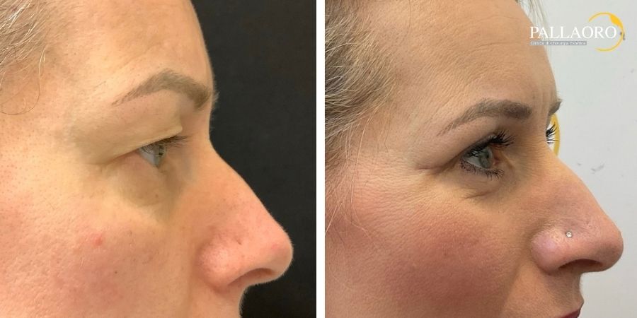 blefaroplastica superiore e laser frazionato (3) blefaroplastica superiore e laser frazionato (3)