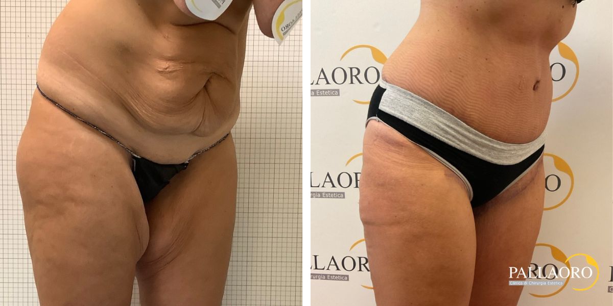 body lifting addominoplastica lifting cosce (1)