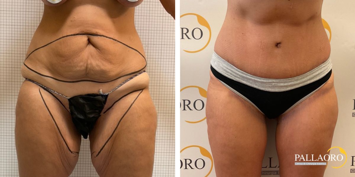 body lifting addominoplastica lifting cosce (2)
