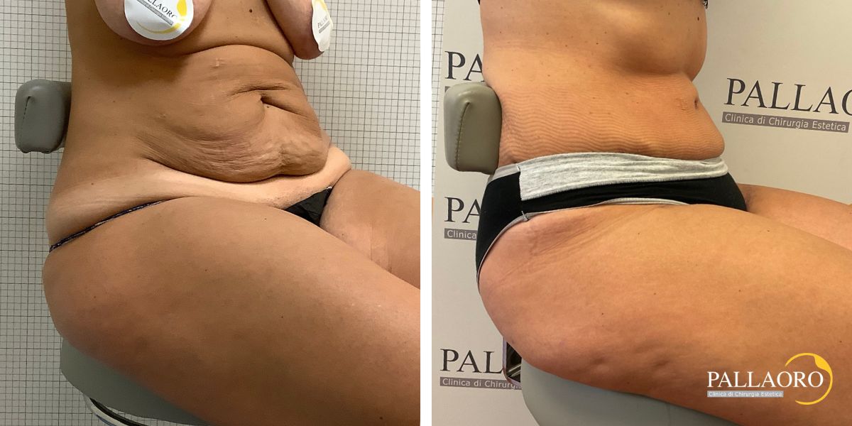 body lifting addominoplastica lifting cosce (4)