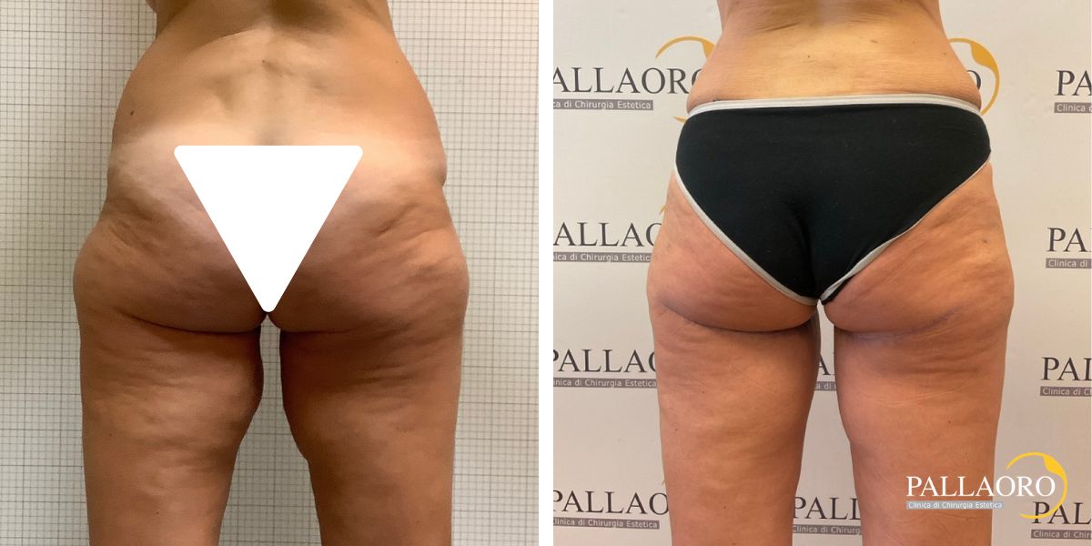 body lifting addominoplastica lifting cosce (5)