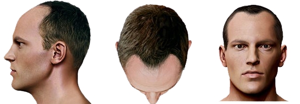 Alopecia Androgenetica stadio III