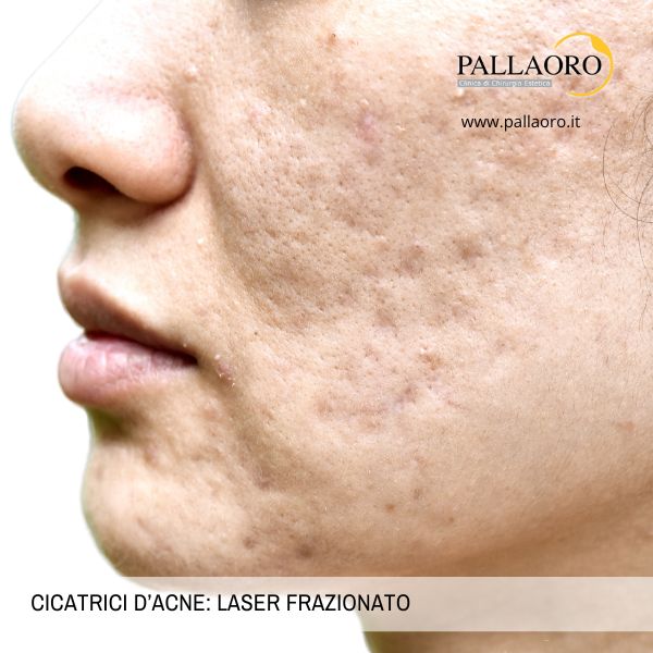 cicatrici acne laser frazionato Cicatrici d'acne: Quale laser scegliere?