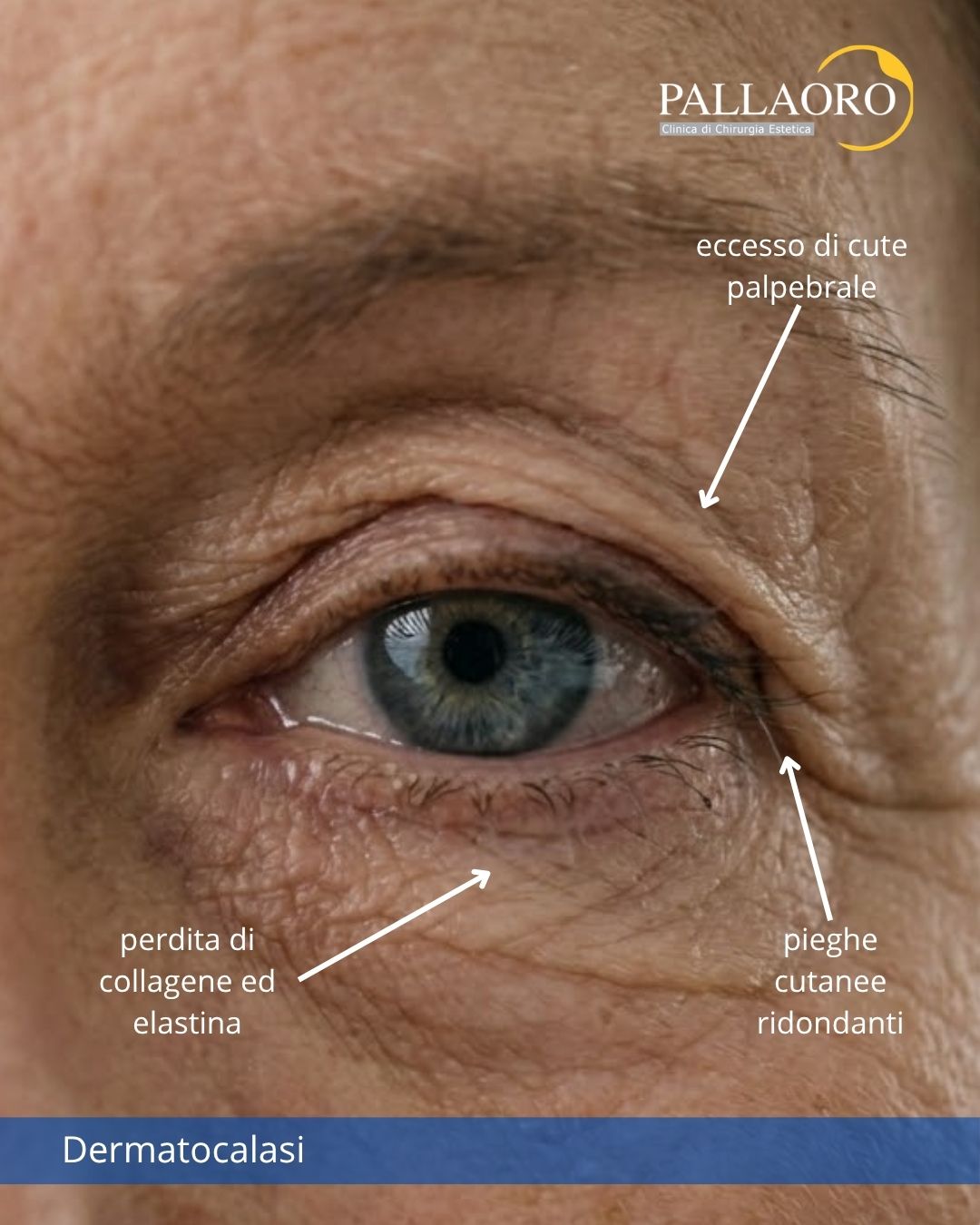 dermatocalasi dermatocalasi