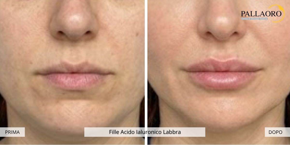fille labbra prima dopo 1