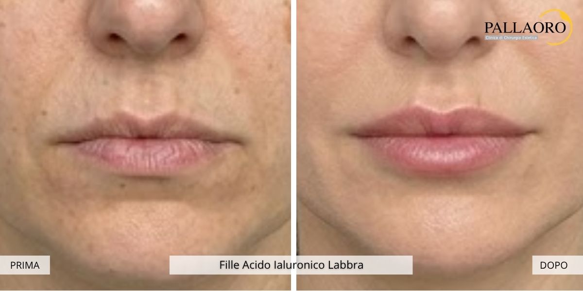 fille labbra prima dopo 2