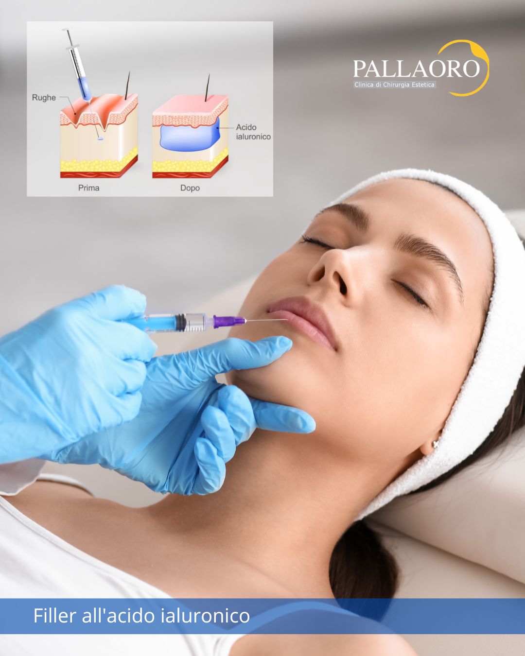 filler acido ialuronico filler acido ialuronico
