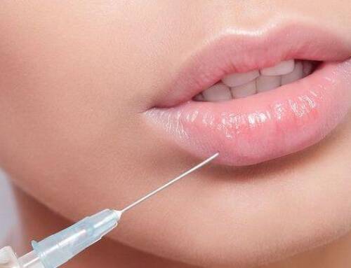 Filler labbra durata del risultato e del trattamento