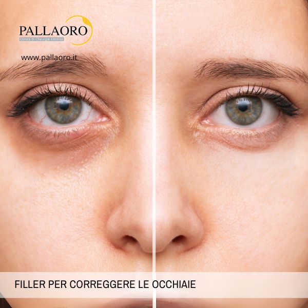 filler per correggere le occhiaie Correggere le Occhiaie con il Filler all'Acido Ialuronico