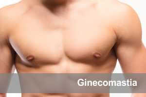 ginecomastia menu