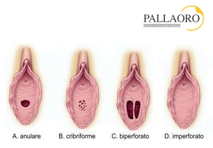 imenoplastica tipi imene