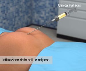 Lipofilling - infiltrazione cellule adipose