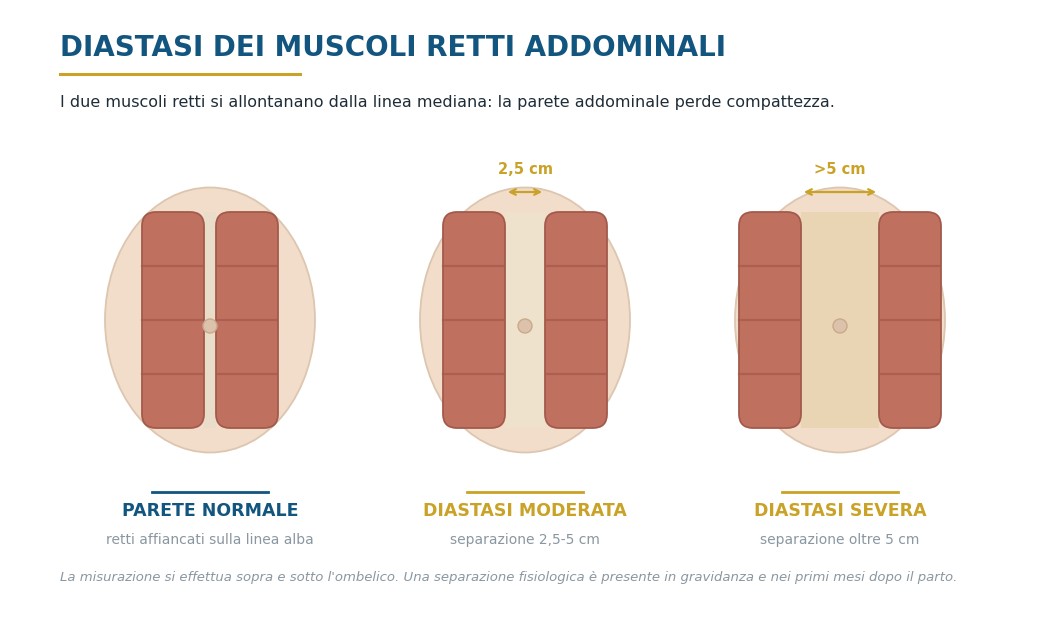 Diastasi dei muscoli retti addominali: parete normale, diastasi moderata e severa a confronto