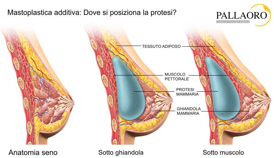 intervento mastoplastica additiva posizione protesi intervento mastoplastica additiva posizione protesi