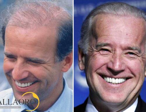 Trapianto capelli Joe Biden