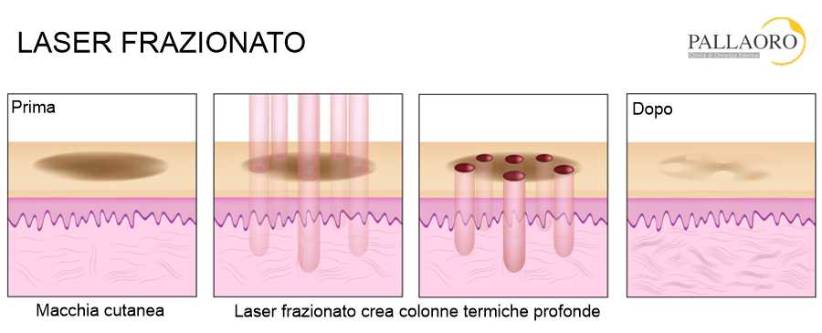 laser frazionato macchie laser frazionato macchie grafico