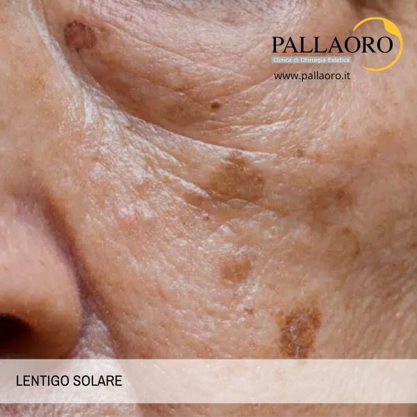 lentigo solare lentigo solare