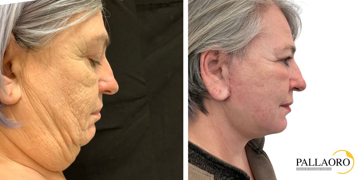 lifting viso collo 260120-1 lifting viso collo 260120-1