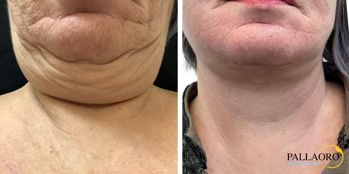 lifting viso collo 260120-2 lifting viso collo 260120-2