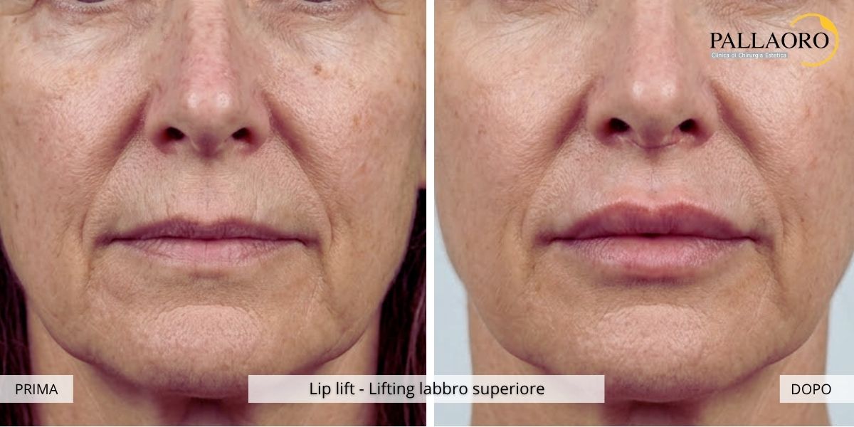 lip lift prima dopo 1