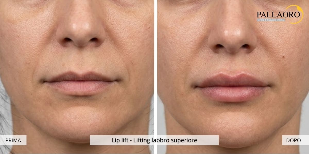 lip lift prima dopo 2
