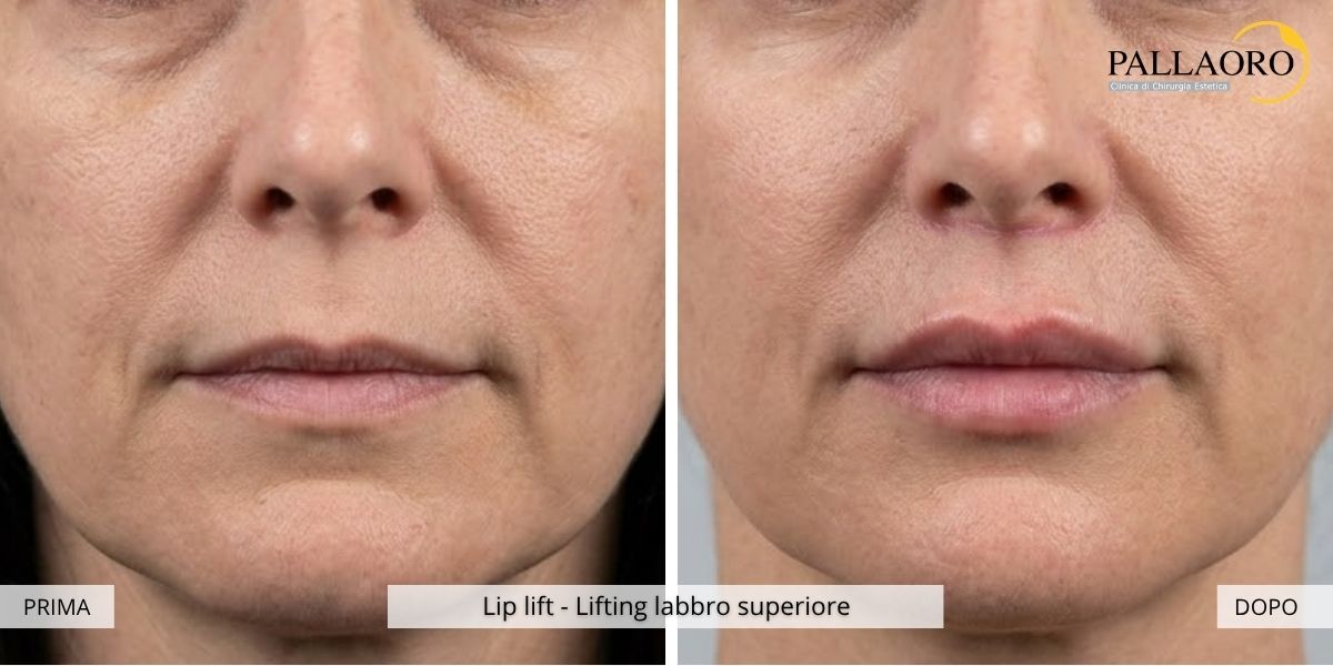 lip lift prima dopo 3