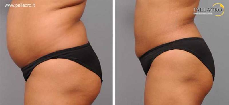liposuzione effetti collaterali