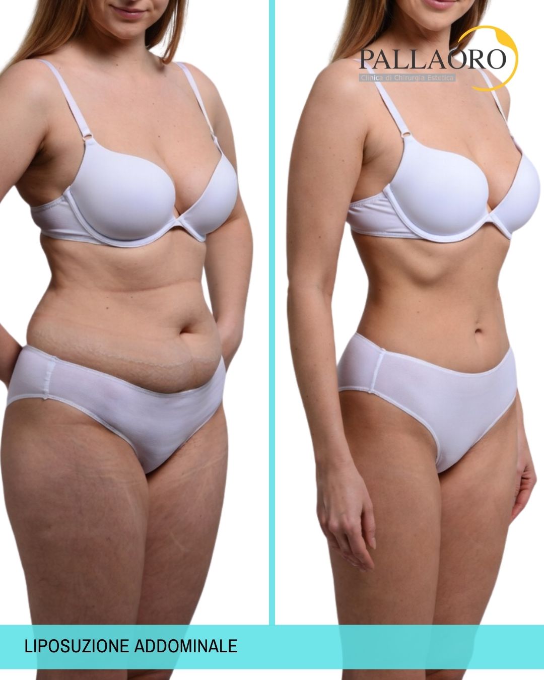 liposuzione addominale
