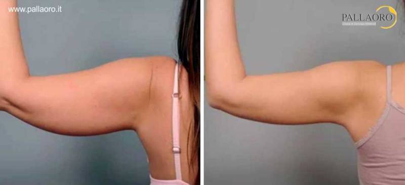 liposuzione braccia foto prima dopo