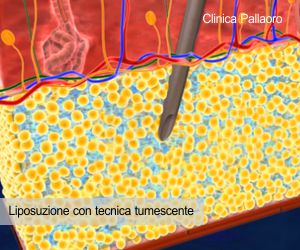 liposuzione con tecnica tumescente